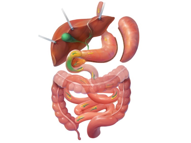 >Gastric Sleeve / Sleeve Gastrectomy