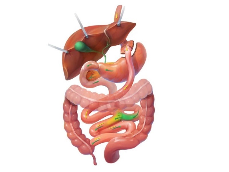 >Gastric Bypass (Roux-en-Y)